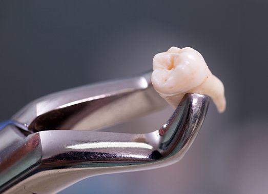 Clasp holding extracted tooth