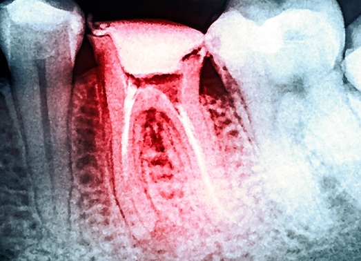X-ray of damaged teeth proper to tooth extractions