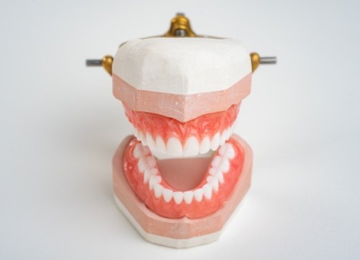 Model of smile restored with denture